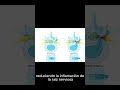 Tratamiento Hernia Discal Lumbar sin Cirugía: Infiltración Epidural Caudal Explicada