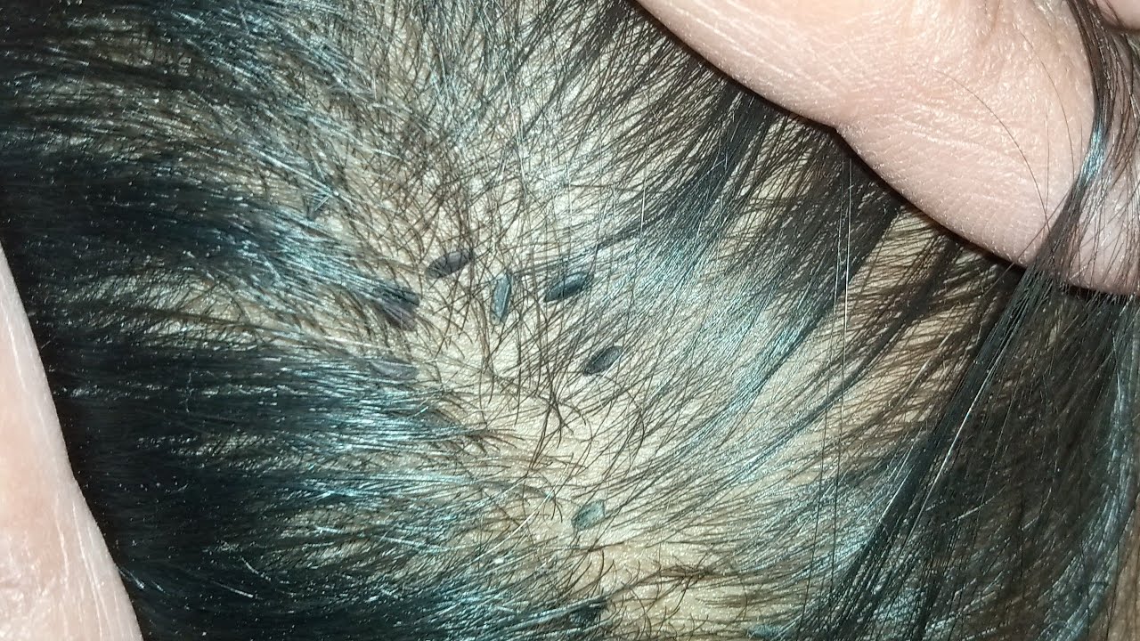 Hair Lice Eggs Removal (Nits Picking)