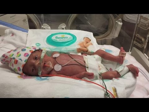 Video: ¿Es posible que un gemelo nazca prematuramente?