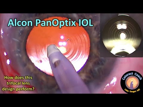 panoptix alcon iol trifocal surgery
