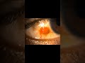 #Capillary#Haemangioma#Conjuctiva#With#Feeder#Vessel#Benign#Vascular#Tumour#SEH@Karur#