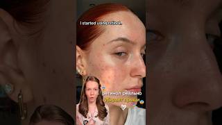 Ретинол реально убирает прыщи Арт WB WW159513 Ozon 2806910592 прыщи ретинол уход