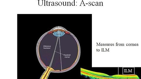 Chapter 7: Biometry for cataract surgery