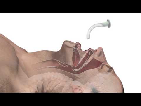 Video: 4 načini zdravljenja zaprtja po operaciji kile