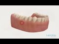 Ulcer - Lapointe dental centres
