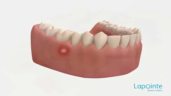 Why is my gum white in one spot? (2023)