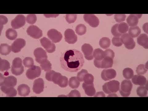 Malaria: Plasmodium vivax sediaan darah tebal dan tipis cara Giemsa stain