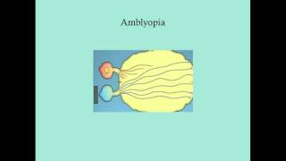 Amblyopia - CRASH! Medical Review Series