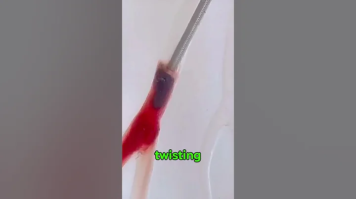 This Tiny Device Can Remove Deadly Blood Clots! 🩸 | Millis Spinner Explained #technology