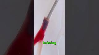 This Tiny Device Can Remove Deadly Blood Clots! 🩸 | Millis Spinner Explained #technology