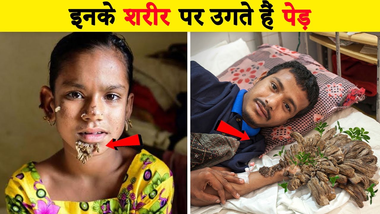 इनके शरीर पर पेड़ उगते हैं Tree Man Disease Turns People into Tree Amazing facts in hind
