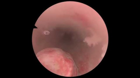Polypectomy / Polyp Removal - New Features for Virtual Reality Surgical Simulation