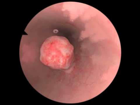 Video: Jak odstranit adenomatózní polypy?