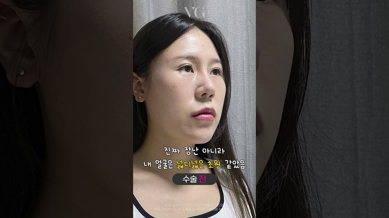 [Вэри Гүүд Гоо Сайхны Мэс Заслын Клиник] Миний нүүрний хэлбэр засалтын амжилтын түүх!!