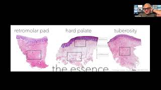 Immediate implants/immediate loading | Long term follow-up (20 years) - Dr Iñaki Gamborena