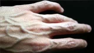 How To Get Rid Of Varicose Veins On Hands Fast