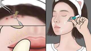 ASMR Удаление угрей в домашних условиях| DIY Спа для очистки угрей и белых угрей| Meng's Stop Motion