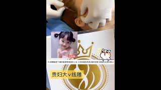 大v线雕提升 改善下垂肥肥脸~！马来西亚微整形~