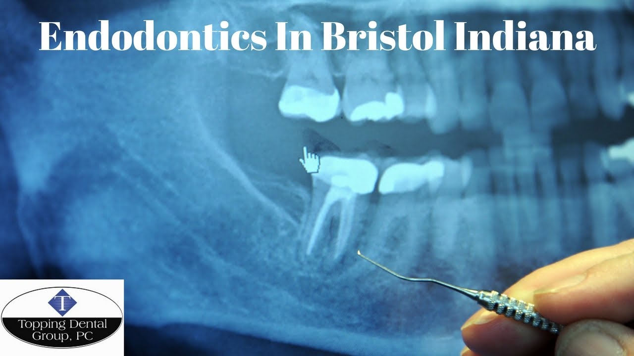 Endodontics In Bristol Indiana YouTube