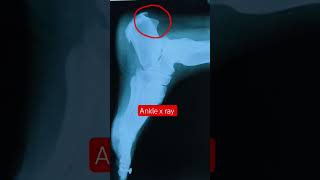 Ankle x ray #healthtips #xray #anklepain #awareness #medical #doctor