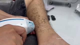 ⚡️RUIPU-Hot loading desktop case diode+picosecond laser machine hair removal effect showcase