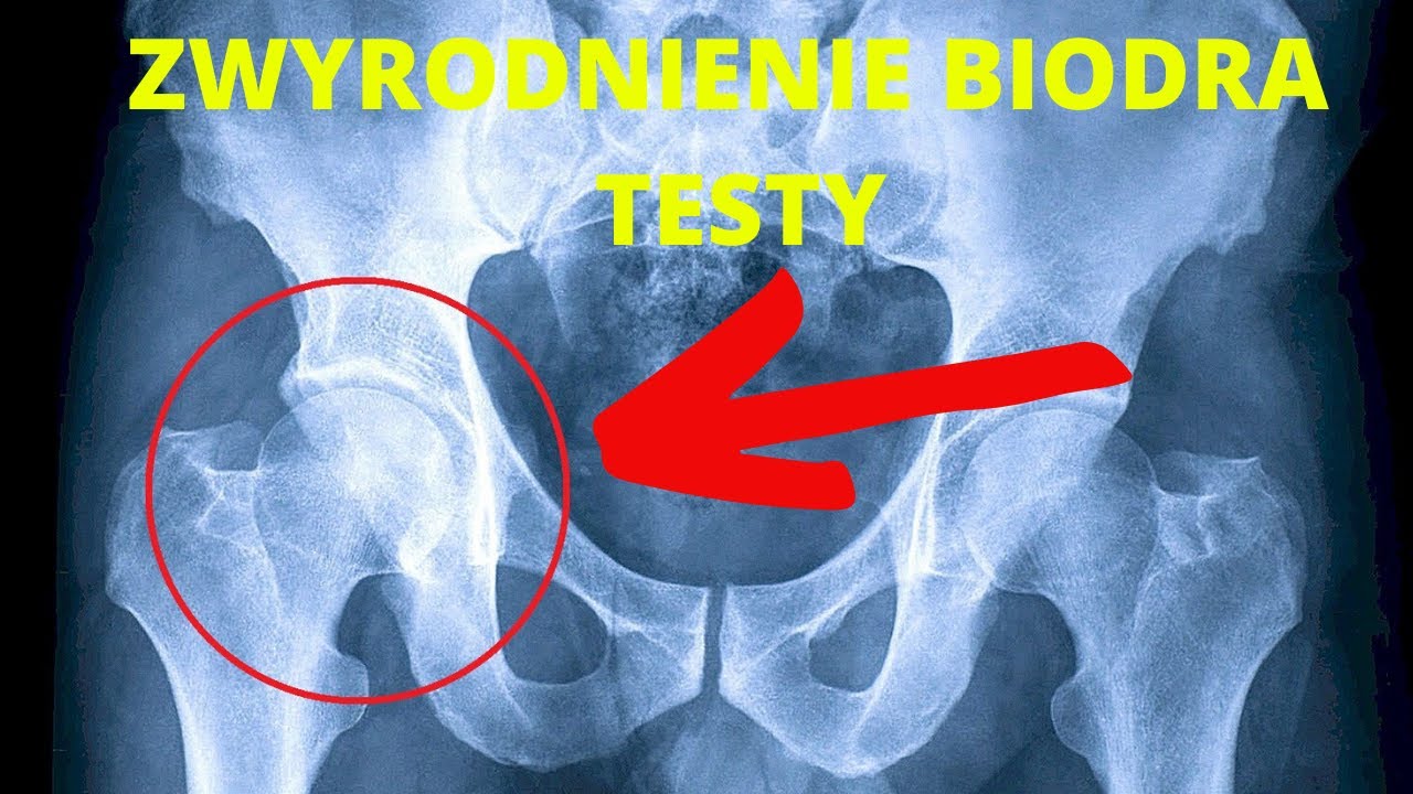 ZWYRODNIENIE BIODRA- testy [FIZJOIDEA 64] - YouTube
