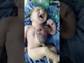 Ectopia cordis | Delieverd at Lahore General hospital | by Dr Shazia Ayaz | Gynaecologist | Rare
