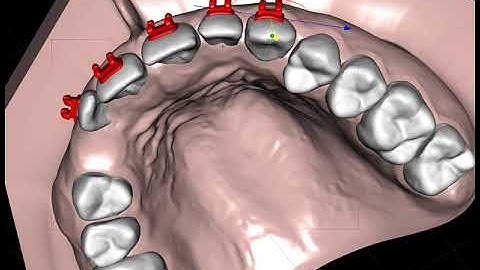 Correctly positionning an orthodonitc  bracket on a canine with  the straight wire system