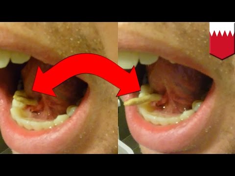 Man squeezes salivary stone out from tongue - TomoNews