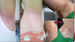 تقشير تحت الابط طبيعي في المنزل بس فقط ٣ خطوات Underarm peeling  تقشير طبيعي   يوسف الصقر