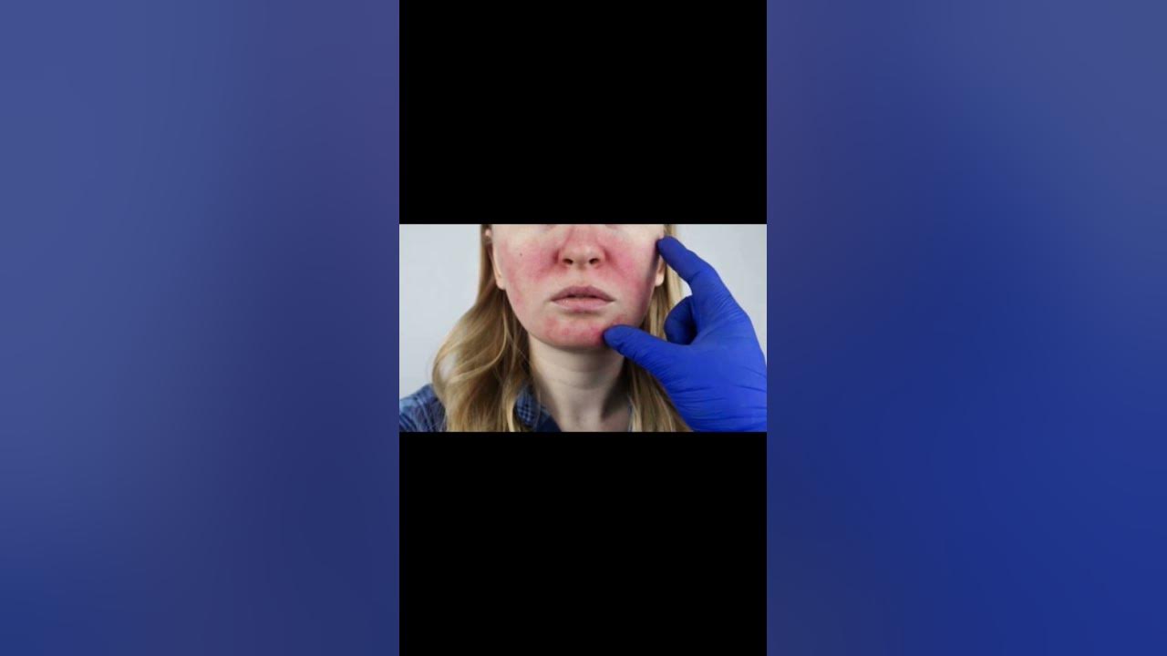 is-laser-treatment-safe-for-skin-stretch-marks-and-scars-youtube