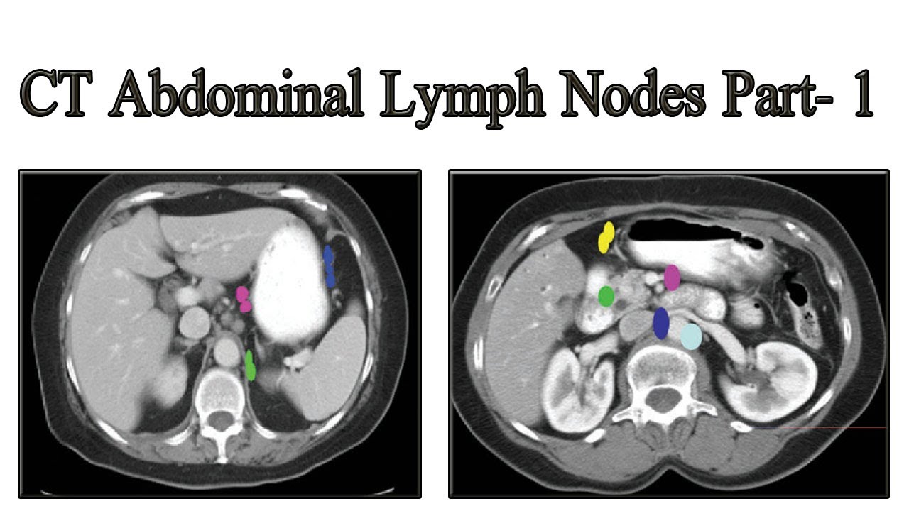 Abdominal Ct Scan Lymph Nodes