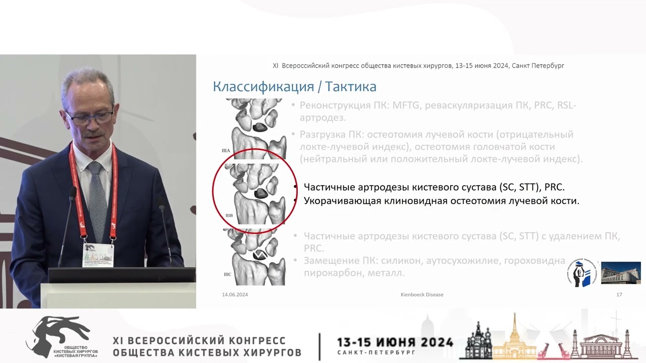 Семенкин О.М.: оперативное лечение пациентов с III стадией болезни Кинбека.