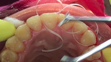 Bonding fixed permanent retainer in orthodontics with dental floss Asker Orthodontics (twist flex)