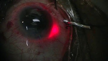 ABiC using the iTrack Catheter - external advancing of the catheter - Dr. Paul Singh, MD