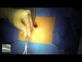 Umbilical Hernia Repair at California Hernia Specialists