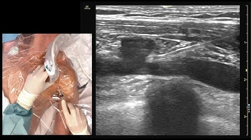 Ultrasound-Guided Subcalvian Vein Cannulation