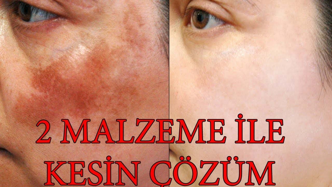 GÜNEŞ LEKESİ GİDERİCİ MASKE - SIKILAŞTIRICI - DOĞAL YÖNTEM - DOMATES