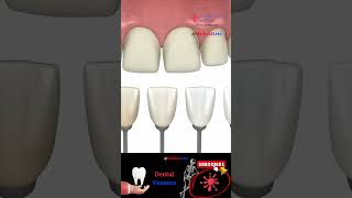 Dental Veneers Procedure Steps #Shorts