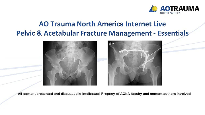 Associated Both Column FracturesDr. Keith Mayo