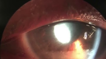 Cataract Surgery for Lens Particle Glaucoma