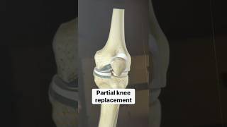Partial knee replacement or UKR- How it’s done #partialkneereplacement