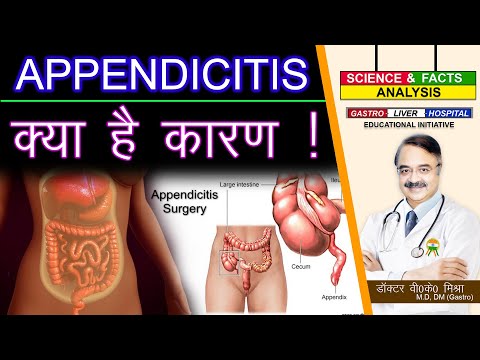 Appendicitis ! || What Causes Appendicitis