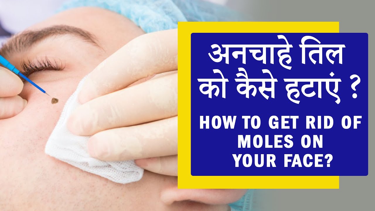 How to Get Rid of Moles on Your Face? Mole Removal Treatment in Delhi | Dr. PK Talwar