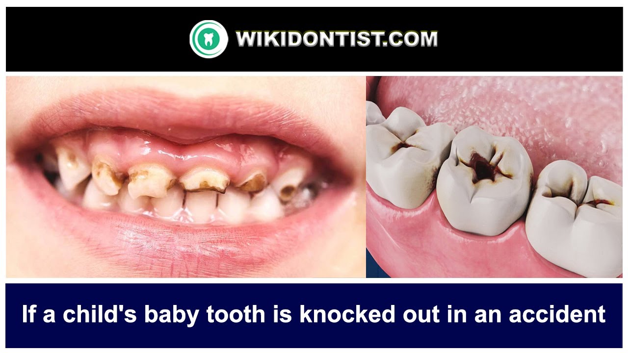 If a child's baby tooth is knocked out in an accident Video by Dr
