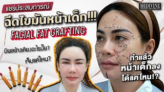 รีวิวฉีดไขมันหน้าเด็ก จากคนไข้จริง! หลังทำไปแล้วทำไมหน้าเปลี่ยนเป็นแบบนี้!! หน้าเด็กลงแค่ไหน ไปดู!!