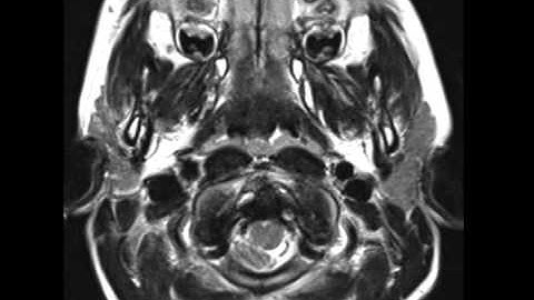 Chiari I Malformation