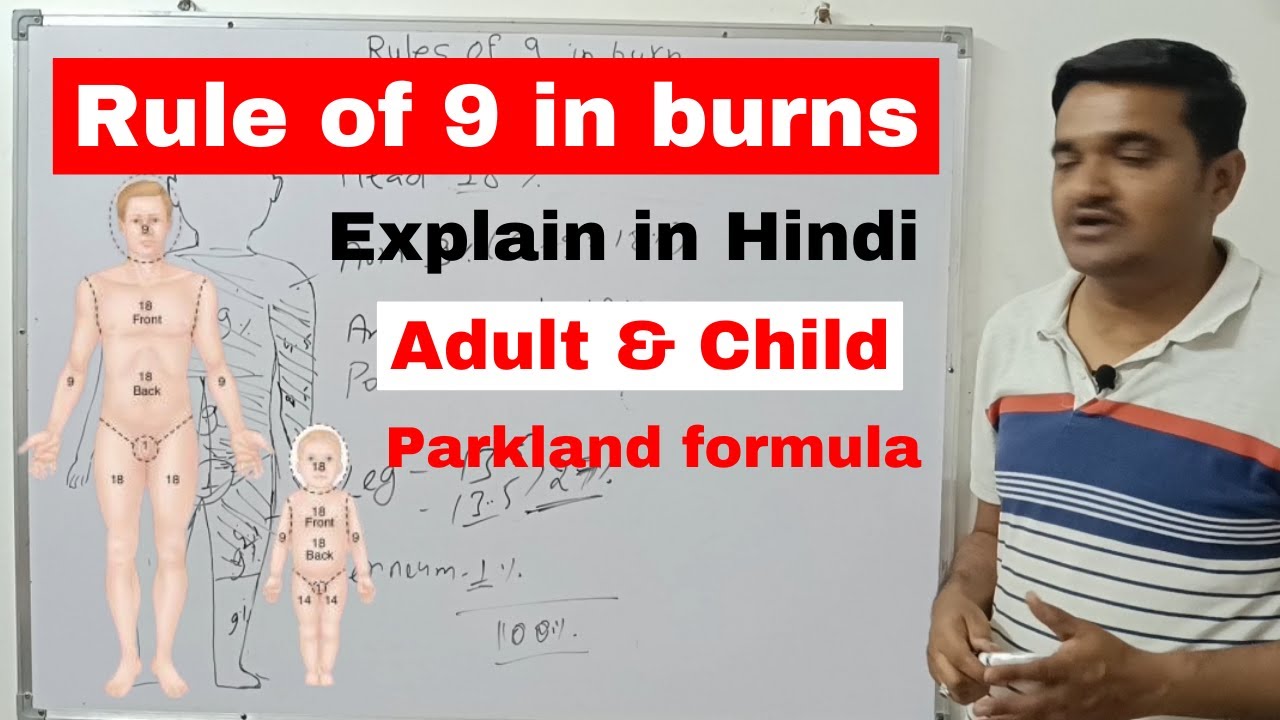 Rule of nine in burns nursing | Rule of 9 | parkland formula | medical surgical nursing