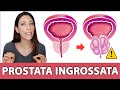 ⚠️ Ipertrofia prostatica benigna, come prevenire e affrontare l'ingrossamento della prostata