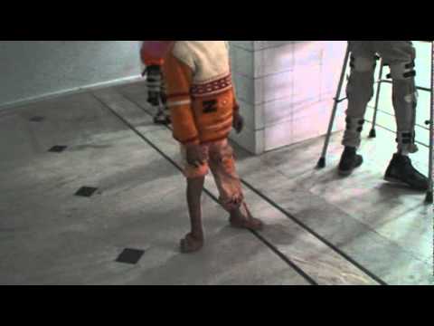 PRETREATMENT VIDEO OF CLUBFOOT TREATED ELSEWHERE-D...